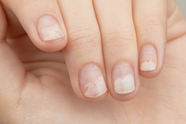 Onycholysis of nails – what is it, how does it manifest itself and how can it be curbed?