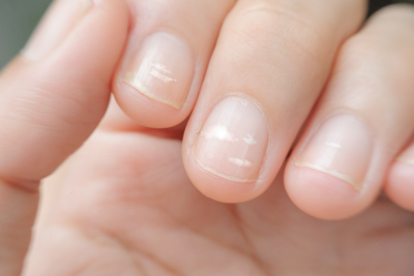 What do white spots on nails mean? Where do they come from and how to treat them?